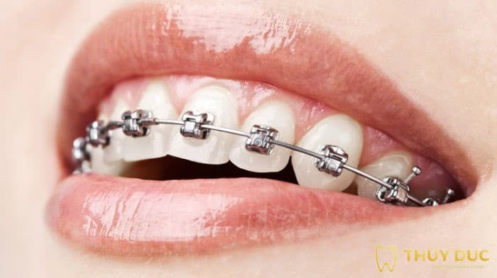 Chi phí niềng răng mắc cài kim loại tự động